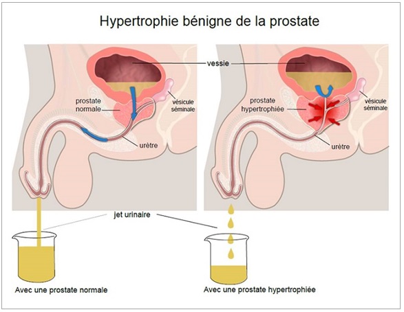 traitement prostate edmark