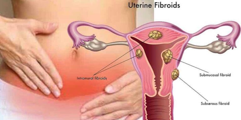 traitement Fibromes