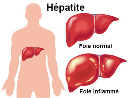 edmark traitement hepatite